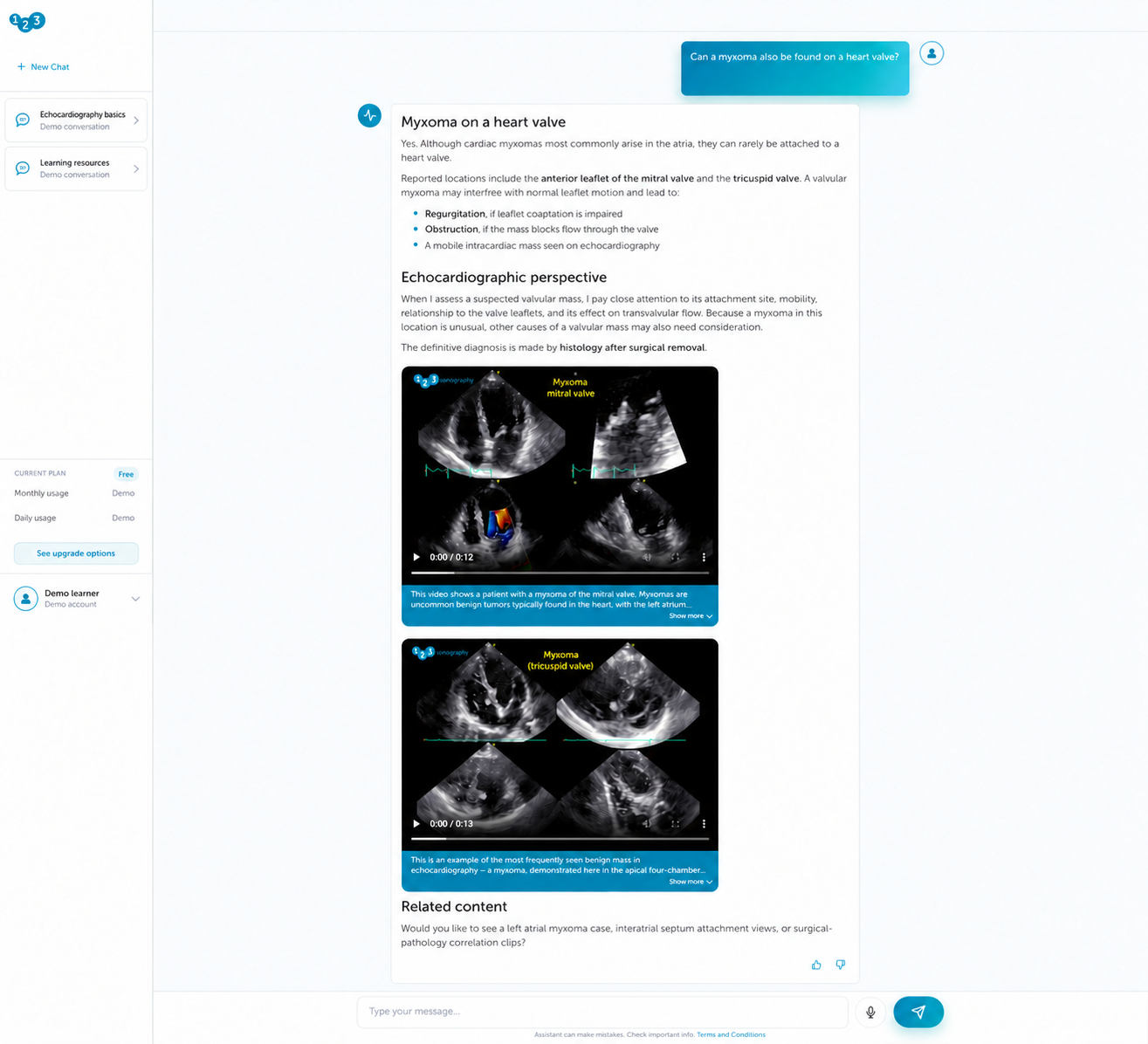 Anonymized SonoAssistant results showing an educational answer, two echocardiography teaching videos and related content